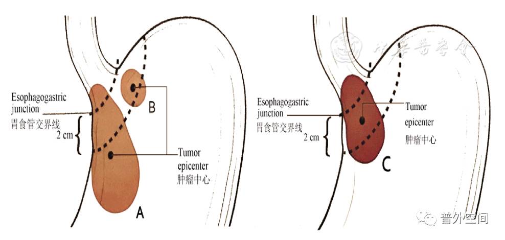 胃癌tnm最新分期,胃癌tnm分期图谱