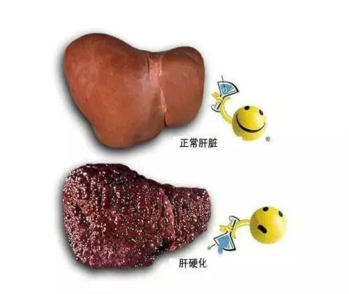 当心肝硬化晚期并发症！大吐血！附防治方案