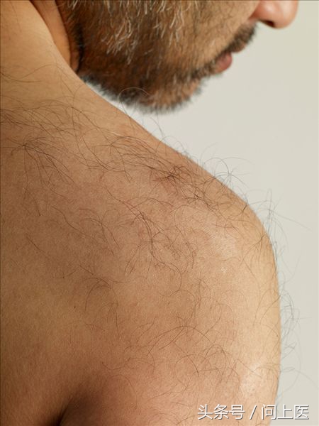 全身有体毛就是多毛症吗,病态性多毛症状