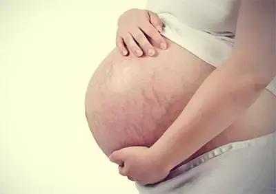 孕期预防妊娠纹产品推荐不油腻,孕妈如何预防妊娠纹只需要五招