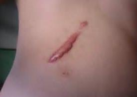 一次水光针=200片面膜？是真的！但为啥我还是不推荐你打水光针？