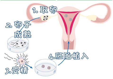 辅助生殖技术——试管婴儿
