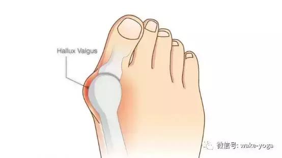 脚趾外翻的真正原因,你的脚趾弯了怎么办