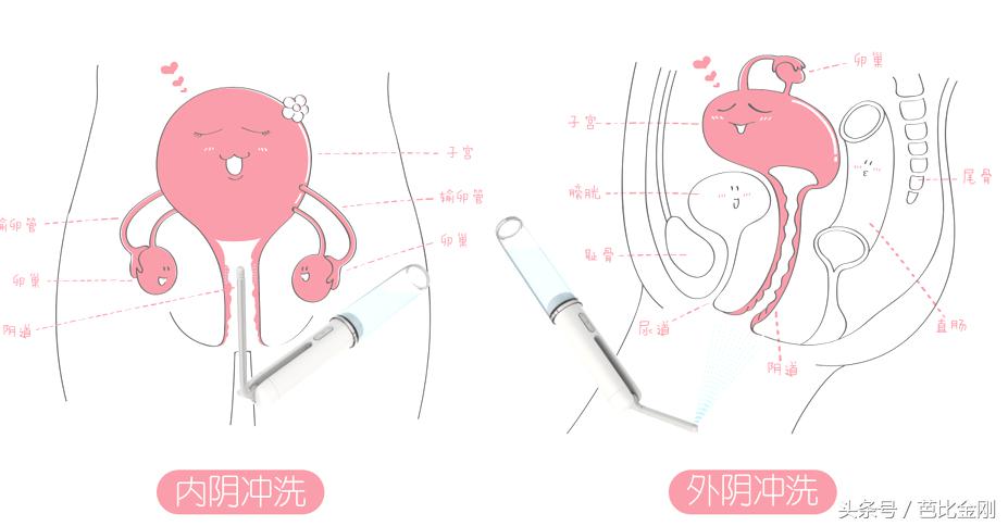 蹲坑时间长容易得痔疮,蹲坑时间太久是痔疮的罪魁祸首吗