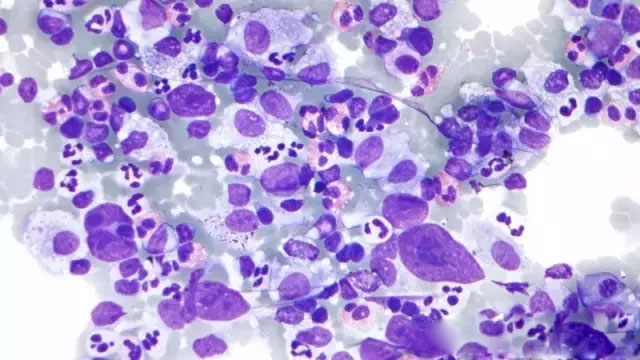 血液肿瘤的CAR-T治疗靶点点评集锦