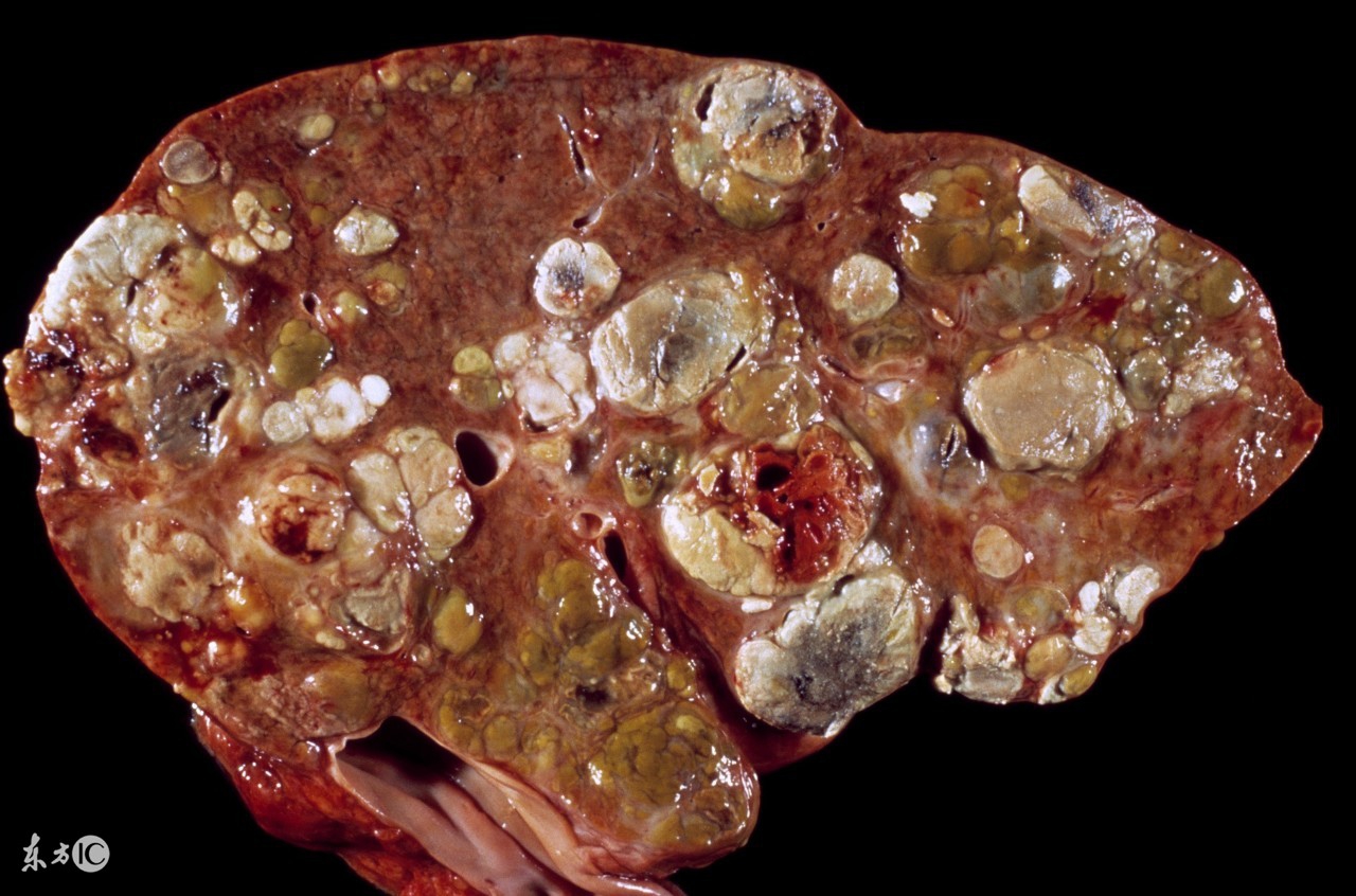 乙肝患者出现肝硬化一般要多久,乙肝患者如何避免肝硬化的发生