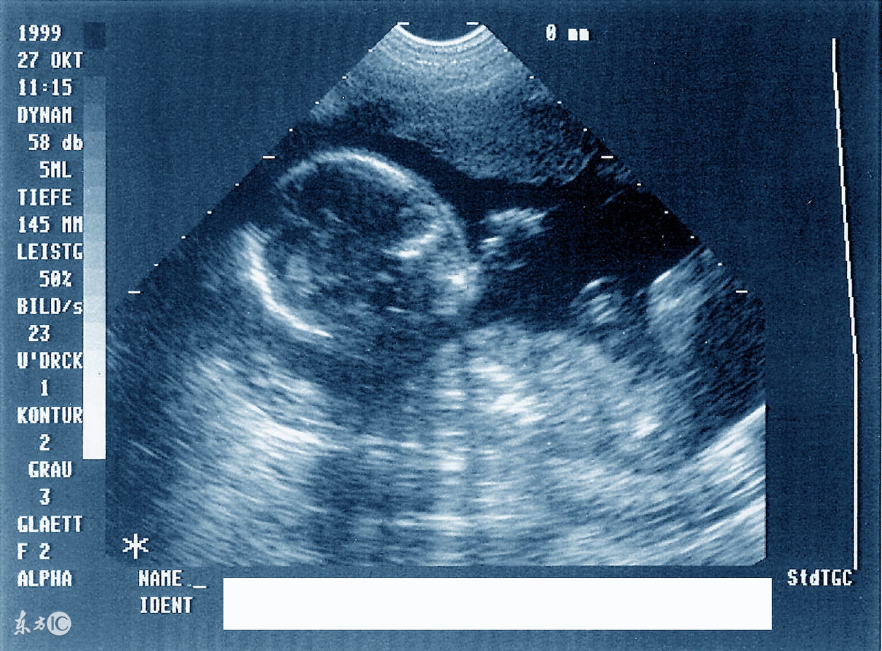 产前诊断孕前一周b超是什么,b超二级产前筛查