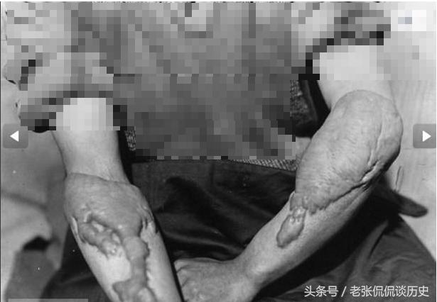 广岛核辐射照片,广岛核辐射是什么原因