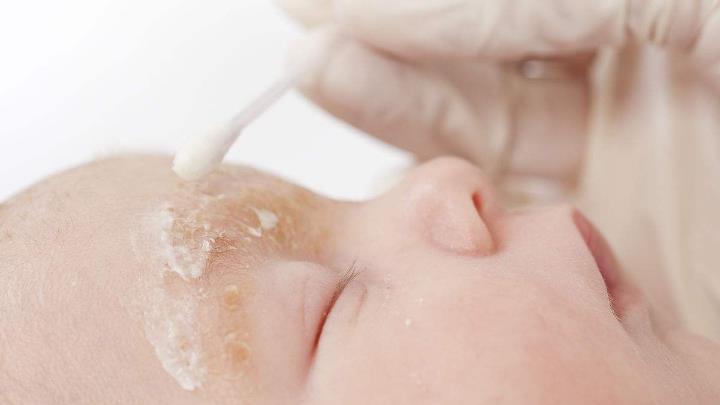 发红发痒还有皮屑是脂溢性皮炎吗,皮肤发红痒脂溢性皮炎