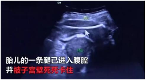 哪些女星是剖腹产,哪些女星是剖腹产的