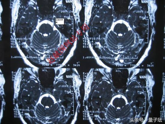 老年人三叉神经痛的最佳解决办法,mvd手术治疗三叉神经痛的标准