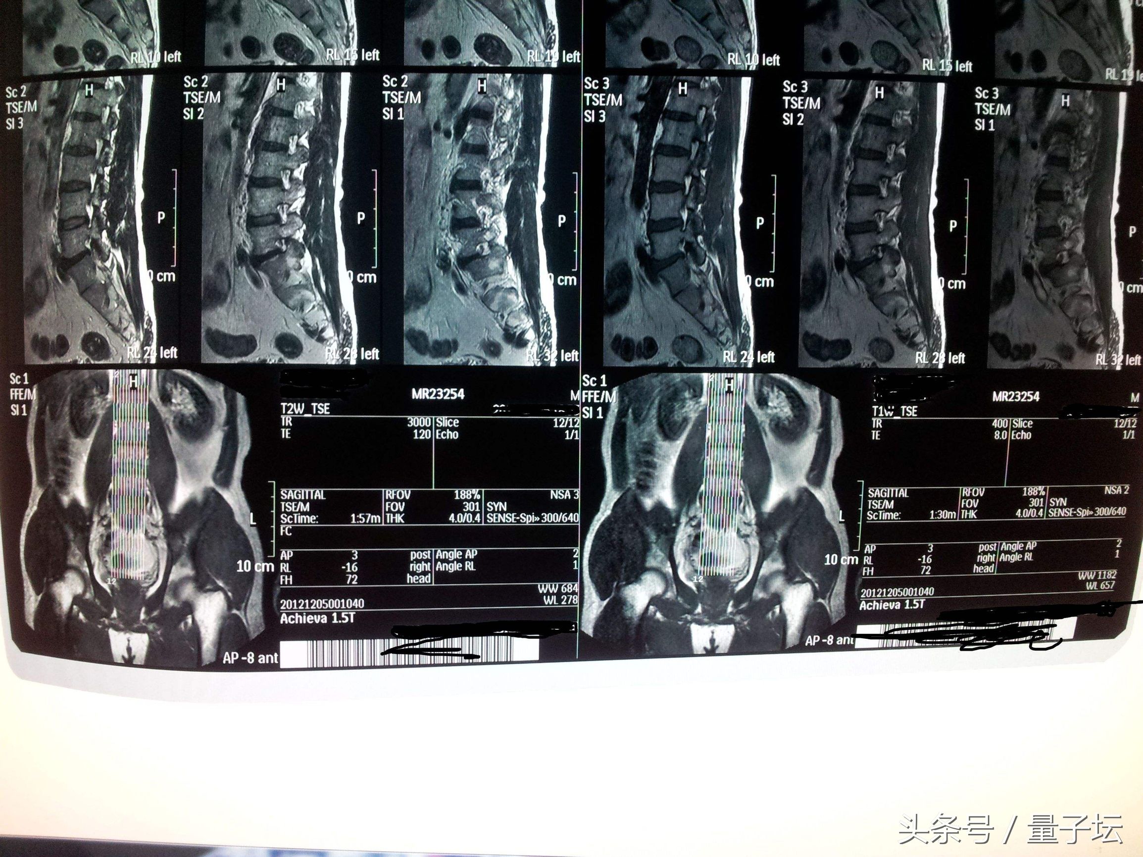 腰椎间盘突出放射到脚,放射科可以检查腰椎间盘突出吗