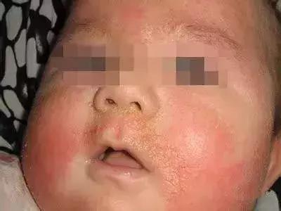 婴儿湿疹妈妈不能吃的22种食物,婴儿湿疹哺乳期妈妈应该忌口什么