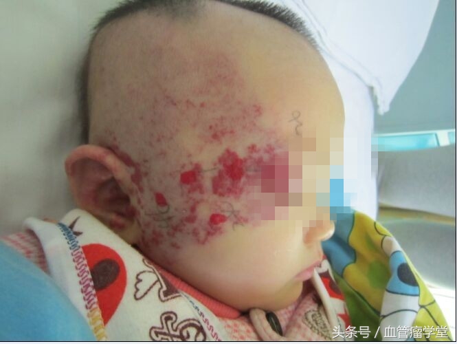 关于血管瘤的问题,医生科普血管瘤的治疗方法有哪些