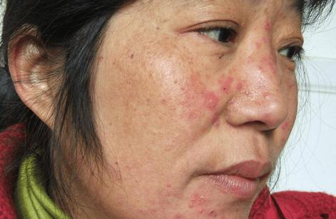 冬季气温寒冷干燥，5个护理建议对激素脸有帮助