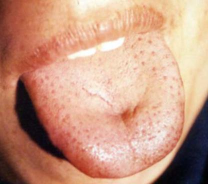 蒲辅周讲舌诊,蒲辅周怎么看舌诊