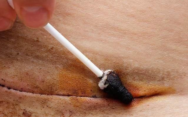 剖宫产怀孕后伤口刺痛怎么办,孕妇剖腹产后浑身发痒咋回事