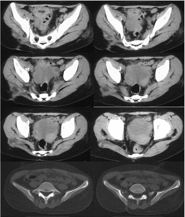 为什么臀部会发育不良,小孩臀部肌肉松弛