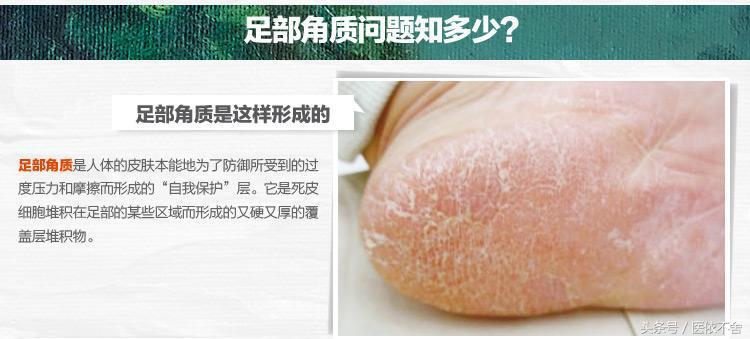 手脚干裂用什么护理霜好得快,防治手脚干裂有良方