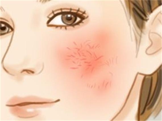 天生敏感的红血丝怎么修护,红血丝敏感皮肤十大排名