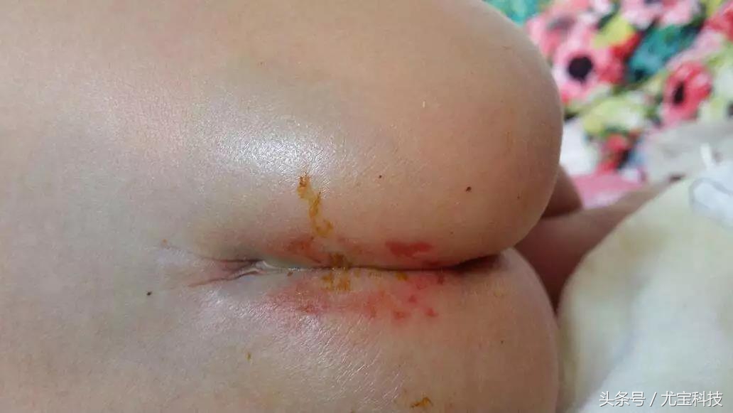 宝宝红屁股因为什么,什么牌子纸尿裤可以预防红屁股