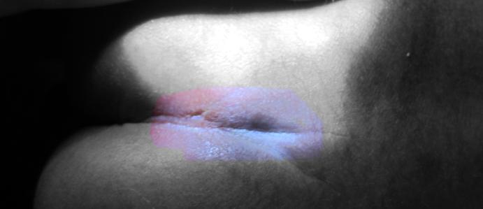 隐性脊柱裂尿床手术要多少费用,孩子隐匿性脊柱裂有影响吗