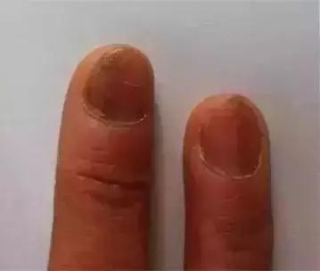 指甲出现哪些症状是有问题的,指甲上有皱纹有什么信号求救