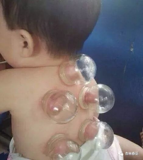 儿童治疗感冒中药小妙招,杏林儿童体质调理