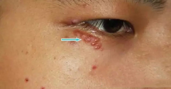 酒渣鼻严重怎么彻底治疗,酒渣鼻难道真的看不好吗