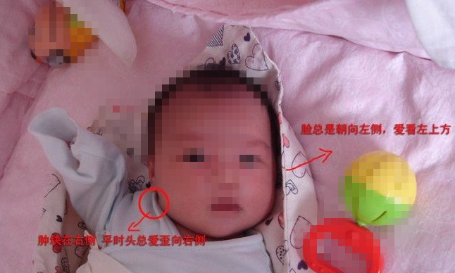 新生儿先天性肌性斜颈嘴巴是歪的,宝宝得了斜颈脖子歪怎么治