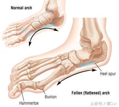 脚底板酸痛快速缓解方法,怎么缓解脚底板酸痛