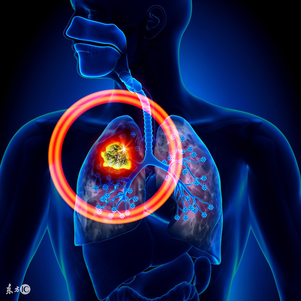 肺癌晚期喉咙疼怎么办,肺癌晚期喉咙痛怎么办