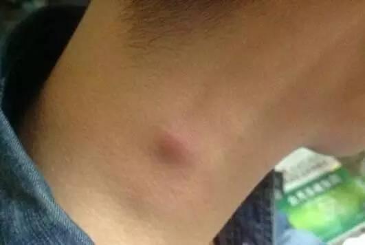 脖子上长了很多小颗粒怎么调理,脖子会出现各种症状及原因