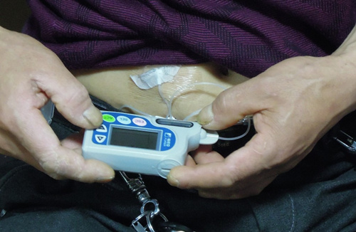 长期打胰岛素出现硬结怎么办,用胰岛素注射笔会有皮肤硬结吗