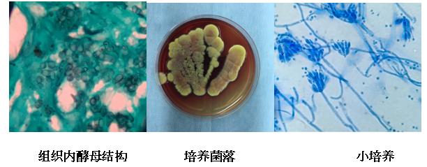 一个病例迸发大智慧!浙大一院皮肤科与北仑分院皮肤科联合在《新英格兰医学杂志》发表论文