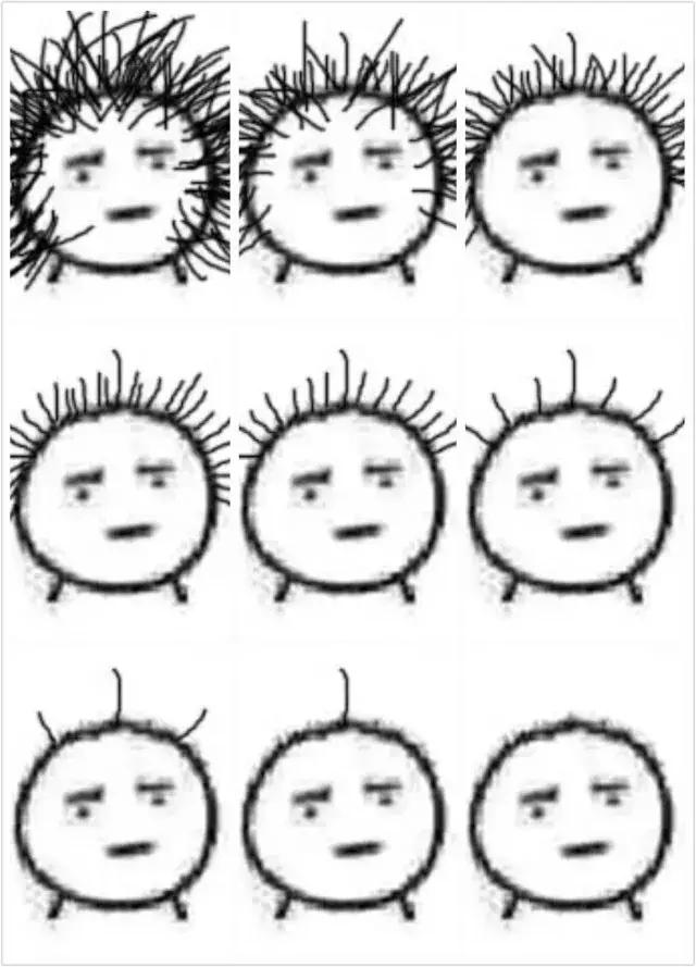 拯救发际线是什么意思,脂溢性脱发发际线稀疏怎么拯救