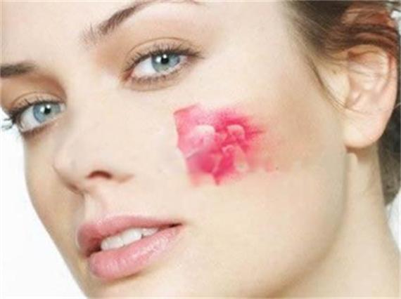 皮肤过敏严重缺水怎么解决,脸过敏紧绷干燥缺水怎么办