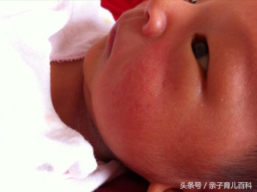 十岁湿疹反反复复不好,儿童嘴角湿疹反反复复