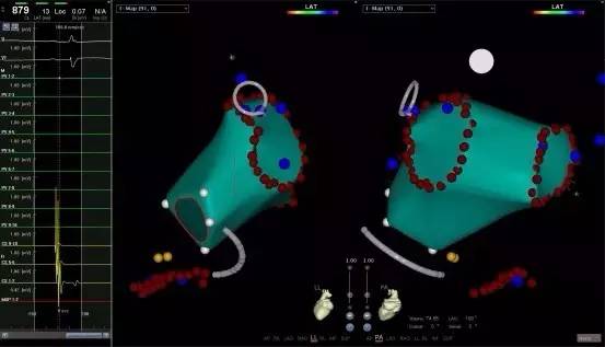 马长生房颤的最好治疗方法,马长生房颤消融后复发