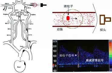 缺血性卒中静脉溶栓指南2022,预防血栓利器