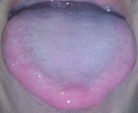 口臭养脾胃,脾胃虚寒口臭偏方