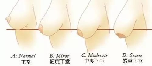 生娃后乳房下垂怎么恢复,预防乳房下垂的方法