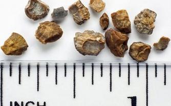 尿路结石的病因病机是怎样的,上尿路结石最常见的典型症状是