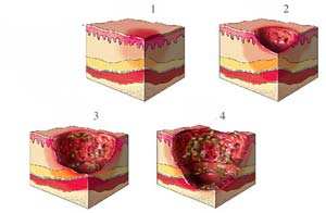 17年的疤痕长了脓包怎么治,17年的腰痛怎么办