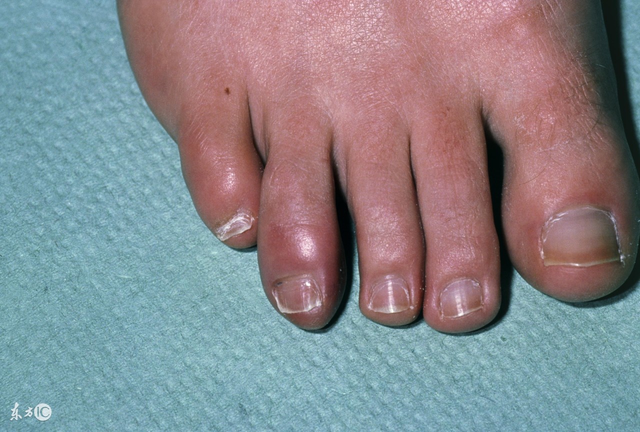 打不死小强该怎么处理,鸡蛋壳治冻疮的方法