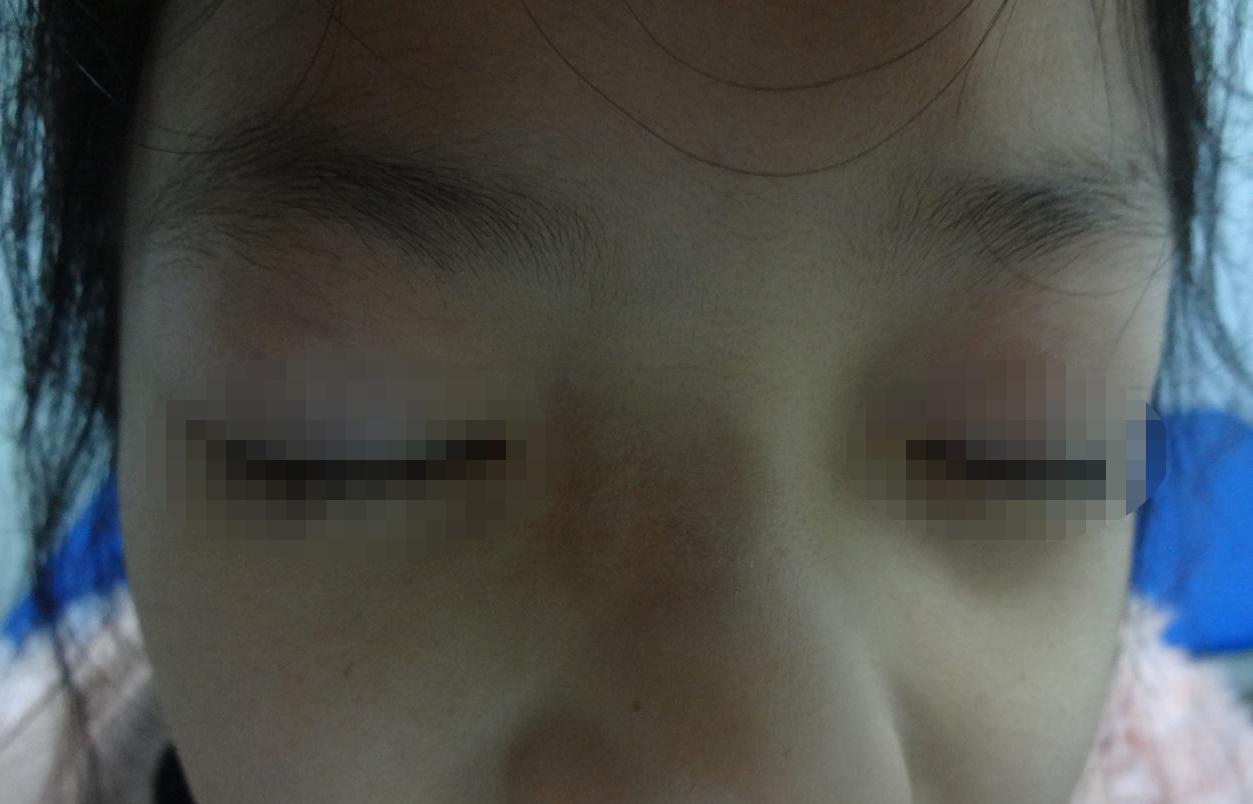 “爸爸，我爱你”——12岁的白癜风“老”患者的温情告白