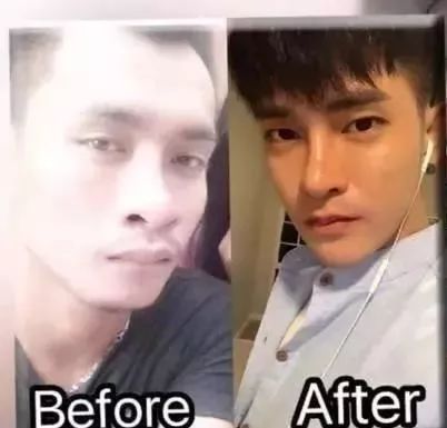 丑男整容变帅哥对比照,长得太丑了找不到老婆