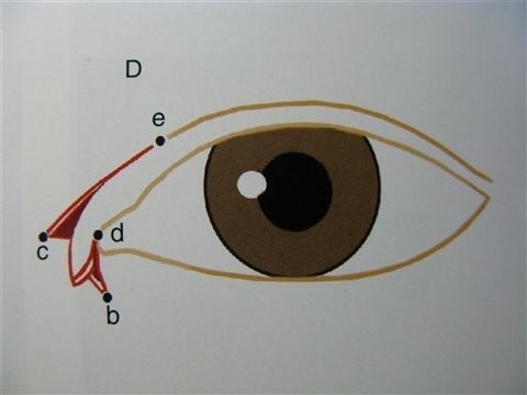 做过埋线还能做双眼皮切开手术吗,陈小剑做双眼皮案例