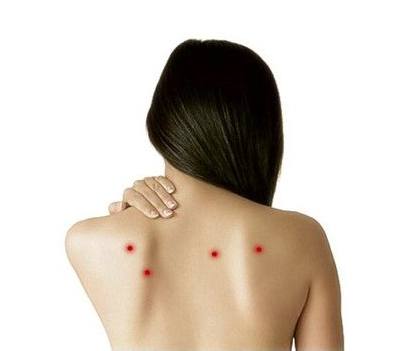 教你如何去除背部痘痘的方法,背部护理也不能大意