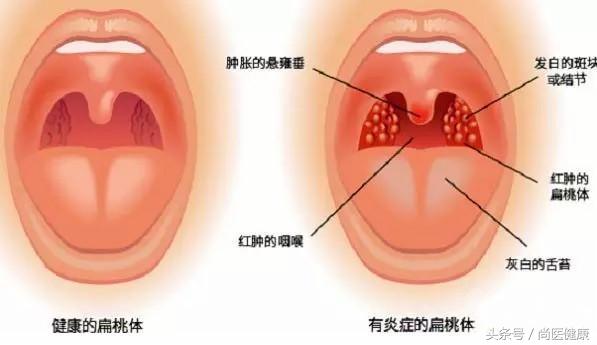 宝宝扁桃体总是发炎怎么办,宝宝扁桃体反反复复